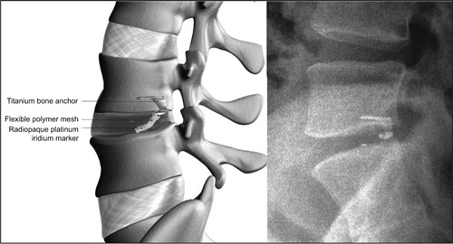 Figure 1 The Barricaid annular closure device.