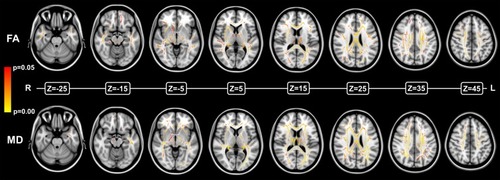 Figure 1 Compared with healthy controls, patients with PNES showed widely decreased FA (upper) and increased MD (lower) on TBSS comparison.