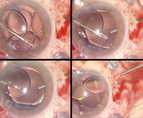 Figure 3 The “Catcher Pole” a bent disposable 23 G Flex loop retinal scraper is inserted into the scleral tunnel and brought in the posterior chamber (A). The tip of the haptic is introduced in the open loop of the catcher (B), the first catch is too distant from the tip (C), moved to the outermost end of the haptic closed around it and retrieved through the tunnel with no effort or damage to the haptic (D).