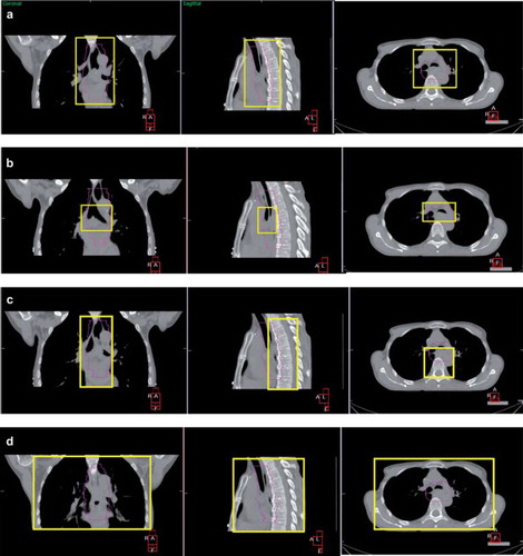 Figure 1. CT and CBCT overlay in coronal and transverse and sagital plane. The area defined in yellow represents C-PTV (a), C-carina (b), C-vertebrae (c) and C-thorax (d) clipbox definition.