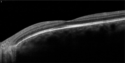 Figure 5 Associated B-scan optical coherence tomography showing normal anatomy of the macula.