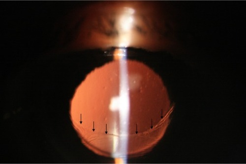 Figure 2 Slit-lamp color photographs at presentation 1 year after phacoemulsification.