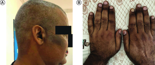 Figure 1. Hyperpigmentation at presentation.(A) Of the face, (B) and hands.