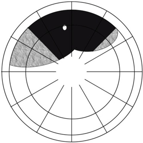 Figure 5 Group 3(B): this category is used to classify the same eyes as in Group 3 according to our different criteria for the corresponding pattern.