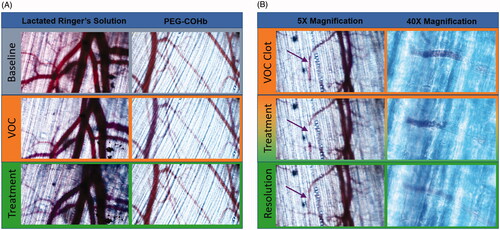 Figure 1. Microvascular Panel. Images were captured by a colour digital camera and adjusted for brightness and contrast to account for differential thicknesses in spinotrapezius muscles and minor shifts in focus. (A) Images were captured at baseline, immediately following ET and immediately after treatment. Each series is taken from a single site in an animal representative of its respective group. VOC is associated with a decrease in perfused vessels and a “blue shift” of larger vessels. Treatment with PEG-COHb but not LRS causes “red shift,” which is associated with a return of oxygenated haemoglobin to those blood vessels. (B) Each set of images is from a different experiment. The 5X image shows a VOC aggregate – denoted by purple arrow – that shifts position during treatment and then dissolves at the completion of treatment. The 40X image shows this effect in a smaller vessel where the aggregate can be seen undergoing a back-ended dissolution. Direction of flow is right to left in these images.