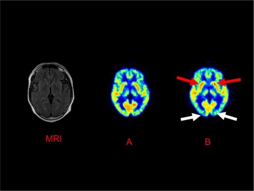 Figure 1 The changes in glucose metabolism using FDG-PET before and after selegiline treatment.