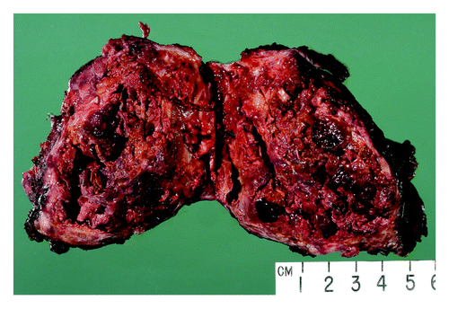 Figure 3. Well demarcated primary pulmonary primitive tumor (PNET) with extensive tumor necrosis inside.