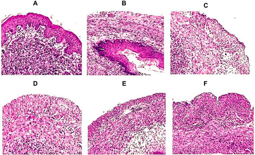 Figure 10 Treatment with a combination of Meth-Gin and FLZ reversed VVC-induced histopathological changes in the vaginal tissues. Vaginal tissues were excised from the mice and the tissues were processed for H & E staining as described in the methodology section. Vaginal tissue from (A) normal control mice (B) Infected mice (C) FLZ-40 mg/kg (D) Meth-Gin-200 mg/kg, (E) FLZ-20 mg/kg + Meth-Gin-200 mg/kg, (F) FLZ-40 mg/kg + Meth-Gin-200 mg/kg.