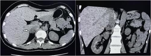 Figure 2 Adrenal non-contrast computed tomography after adrenal artery ablation. Arrow indicates adrenal adenoma.
