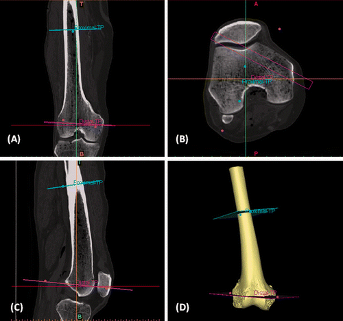 Figure 1. Virtual resection planning of the cadaveric femur in the CAD software. CT images in DICOM format were imported into the CAD software. Axial (B), reformatted coronal (A) and sagittal (C) images were generated. (D) The 3D femur was segmented by the thresholding process. Planes for the bone resection (proximal TP and distal TP) were defined. The planes were 1 mm in thickness, the same as that of the oscillating saw used for osteotomy in the cadaver surgery.
