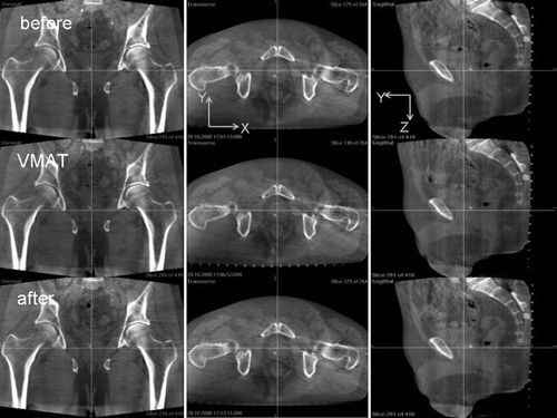 Figure 1.  Cone-beam CT images of a prostate cancer patient with calcification inside the prostate organ. Images in the first row were acquired immediately before VMAT treatment after couch adjustment, the second row refers to images during VMAT delivery, and the third row images were taken immediately after the treatment. Crossing lines indicate the isocenter.