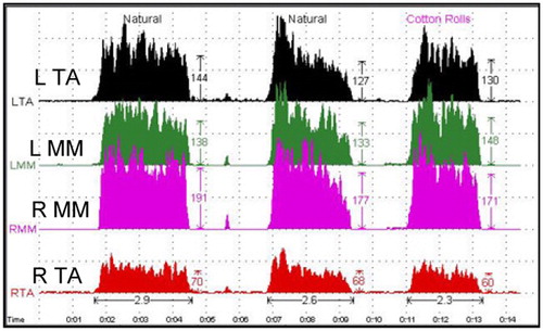 Figure 12. Bilateral surface EMG recordings were performed using EM-2 at the 23-year follow-up. The patient was instructed to clench at ICP and then bite cotton rolls on posterior teeth.