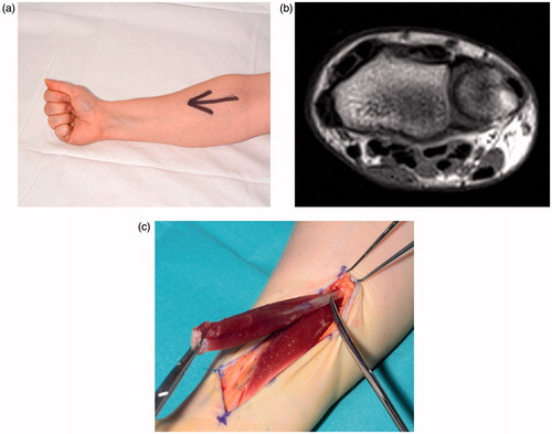 Figure 1. (a) Visible swelling in the right distal volar forearm on clinical examination; (b) An axial section of an MRI scan clearly demonstrating a superficial muscle belly at the level of the distal radio-ulnar joint in keeping with a reversed palmaris longus (*); (c) A sizeable reversed palmaris longus muscle belly in right distal volar forearm.