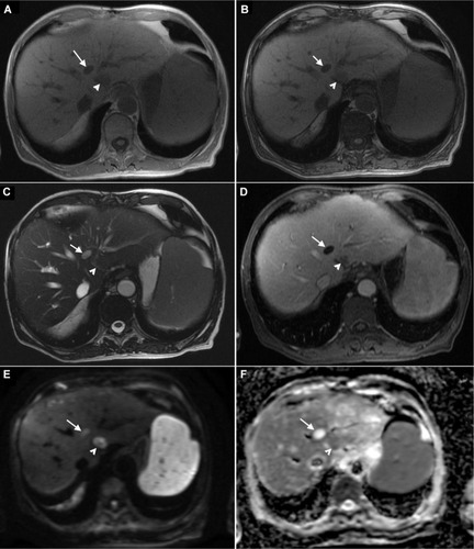 Figure 7 A 64-year-old male with a history of hepatitis C-related cirrhosis, status post liver transplant for HCC.