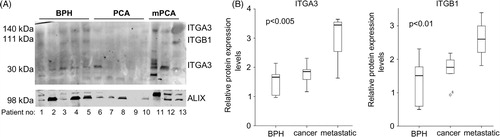 Fig. 3.  (A) Western blot showing the expression of ITGA3, ITGB1 and PDCD6IP in urine-exosomes of patients suffering from BPH, prostate cancer (PCA) and metastatic prostate cancer (mPCA). (B) Quantitative analysis showing the boxplots of the expression of ITGA3 (30kDa variant) and ITGB1, relative to PDCD6IP.