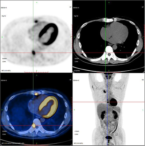 Figure 4 PET-CT presented abnormal glucose metabolism with bone alteration in the 1st right sternocostal joint, sternal body, the T5, T8, T9, and T10, and the 4th lumbar vertebra (L4), with a high possibility of a malignant lesion.