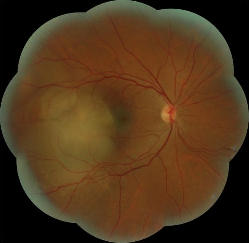 Figure 4 Case 2. Fundus photograph. Unique and massive orange-yellow protruding lesion temporal to macula with an exudative detachment involving the fovea and extending inferiorly.