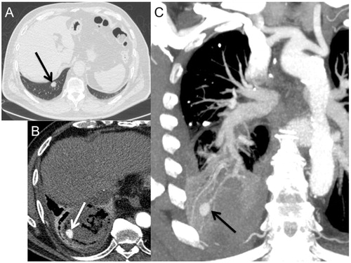 Figure 1. Chest CT. A 74-year-old man received lung PRFA for lung metastases from melanoma. (A) Axial slice (parenchymal window) showing a right basal nodule, 15 mm in diameter (arrow). Low haemoptysis occurred 72 h after the procedure. (B) and (C), axial and coronal (minimum intensity projection) slices (mediastinal window) performed 72 h after the procedure, showing the occurrence of a 17-mm PA in the ablation zone (arrows).