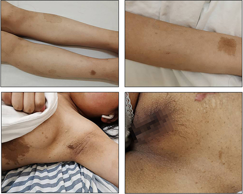 Figure 3 The café-au‑lait macules on the skin surface of different parts of the patient’s body.