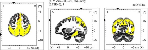 Figure 2 Voxel-wise statistical non-parametric map (SnPM) of sLORETA images in all patients (n=19) during imagery of an general anxiety scenario minus resting state acitivity compared to a general anxiety scenario minus the resting state acitivity in controls (n=15) at the 0.05 significance level after correction for multiple comparisons. Yellow/red shades indicate increased delta sources (red for P<0.1; yellow for P<0.05). Structural anatomy is shown in gray scale (A – anterior; P – posterior; L – left; R – right).