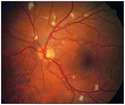 Figure 1 Numerous cotton wool spots typical of HIV retinopathy.