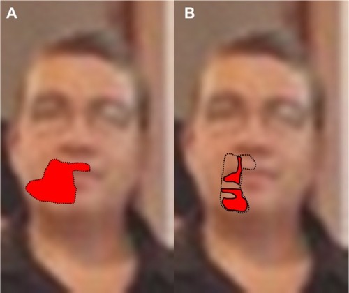 Figure 1 Spontaneous burning pain and numbness associated with allodynia.