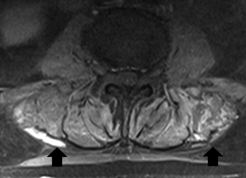 Figure 2. MRI of patient’s lumbar spine. T1 with contrast image with arrows indicating areas of enhancement in lumbar paraspinal muscles