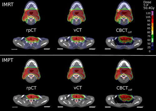 Figure 1. 2D IMRT (top part) and IMPT (bottom part) dose distributions (color-wash) on the investigated CT datasets for PatCA6 in an upper (top row of each part) and lower (bottom row) axial slice. The low and high dose PTVs (green and blue structures), as well as the spinal cord planning organ at risk volume (PRV, red structure) are also shown.