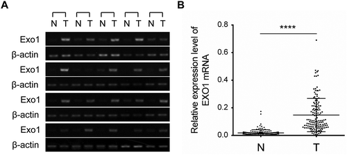 Figure 2. EXO1 mRNA expression levels in HCC and paired adjacent non-tumorous liver tissues. (a) Semi-quantitative RT-PCR data for EXO1 in 20 liver cancer cases and paired normal tissues. (b) EXO1 mRNA levels in 143 paired HCC and adjacent non-tumorous liver tissues measured by the QuantiGene Plex assay. Statistical significance was determined by paired two-tailed Student’s t test. ****, P < 0.0001. Lines from the top represent the 75th, 50th, and 25th of EXO1 mRNA values, respectively. N, normal liver; T, HCC.