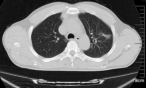 Figure 6 A 16-slice computed tomographic scan revealed that the left lung nodule was significantly smaller than before and was almost absorbed.