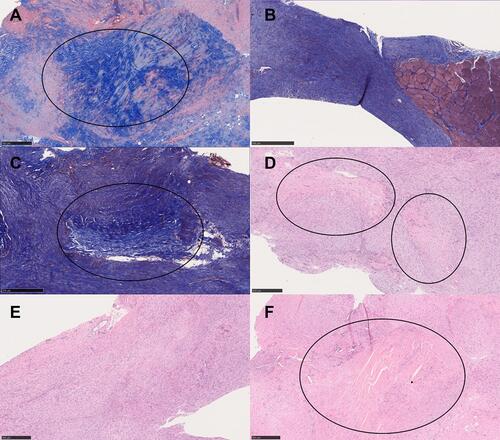 Figure 10 Histology results at 2 weeks with trichrome staining (A–C) and H&E staining (D–F). (A) Trichrome staining of the control group. (B) Trichrome staining of the PLGA membrane group. (C) Trichrome staining of the drug-eluting membrane group. (D) H&E staining of the control group. (E) H&E staining of the PLGA membrane group. (F) H&E staining of the drug-eluting membrane group. The black circle shows the area with dense collagen fiber, which was largest in the drug-eluting membrane group. Scale bar: 500 μm.