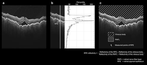 Figure 1 Evaluation of the reflectivity of RPE. (a) The vertical swept-source OCT B-scan images with a width of 12 mm and a depth of 2.6 mm through the center of the fovea were obtained. (b) RPE was defined as the point with the highest reflectivity in the depth direction of the RPE layer by using a plot profile. (c) Ten points of the RPE were randomly selected and their reflectivity was measured and averaged. The averaged reflectivity of the vitreous body and retinal nerve fiber layer (RNFL) as the standard in each image was measured, and we defined the level in the vitreous as 0 and in RNFL as 1 after measuring each averaged reflectivity.