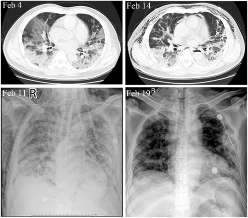 Figure 2 CT and X-ray images of this critically ill COVID-19 patient.