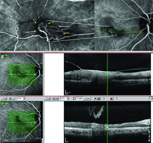 Figure 2 (A) Indocyanine green angiography of the right eye (with magnified foveal area), demonstrating a classic choroidal neovascular membrane (white arrows) with retinal–choroidal anastomosis (yellow arrows). (B) Spectral domain optical coherence tomography (Spectralis® HRA-OCT, Heidelberg Engineering, Inc., Carlsbad, CA, USA) point-to-point registration, showing a taut, V-shaped, hyper-reflective posterior hyaloid attached on the fovea with coexistent macular edema, which resolved after administration of the intravitreal injection of ranibizumab.