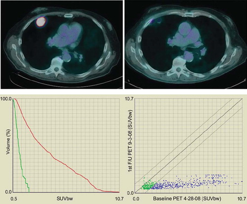 Figure 3. Metabolic tumor response of a biopsy confirmed NSCLC treated by Stereotactic Body Radiation Therapy (SBRT, 60 Gy in 5 fractions). Upper left figure represents PET-CT fusion at baseline; the upper right figure represents metabolic response at three months post completion of SBRT. By visual inspection, the uptake has resolved. The lower figures represent two ways of plotting data gathered by deformable registration-based voxel to voxel mapping. The follow up PET scan was mapped onto the baseline PET to derive voxel specific response data which can be plotted in individual uptake distribution graphs for the two PET scans (lower left), or a scatter plot which tracks uptake changes on a voxel by voxel basis (lower right). The lower left graphs confirm that FDG uptake at three months post SBRT (display in green) is much reduced compared to baseline (red), with SUVmax reduction from 10.7 to less than 2. The lower right scatter plot shows all voxels in blue in which the SUV has decreased by more than 10%. Voxels which show an increase or decrease of 10% over baseline are rendered in green. Voxels that would have an increase in SUV by more than 10% would have been rendered in red in the upper left aspect of the plotted area. In this particular case, virtually all voxels with an initial SUV of 2.5 or higher have decreased to SUV values of 2 or lower. Only voxels with low initial SUV have retained their baseline uptake (green).