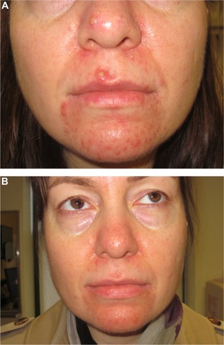 Figure 7 (A) Severe perioral dermatitis (a version of acne-rosacea). (B) Dramatic improvement after initiation of oral isotretinoin.