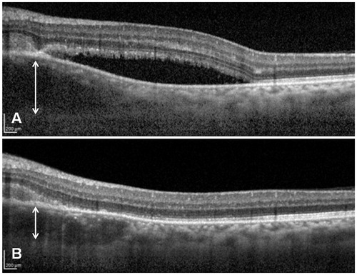 FIGURE 3. Comparison between EDI SD-OCT before (A) and after (B) 2 weeks of systemic corticosteroids. The choroidal granulomatous lesions (a regional granulomatous reaction in the choroid) appear as a hyporeflective thickening of the choroid. The thickness of the granuloma decreased from 568 to 356 μm after treatment.