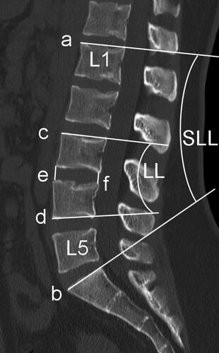 Figure 1. CT value measured from pre-operative CT scan. (a,b) lumbar lordosis (LL), (c,d) segmental lumbar lordosis (SLL), (e) Anterior height of the intervertebral space, (f) Posterior height of the intervertebral space, SLL: segment lumbar lordosis, LL: lumbar lordosis.