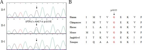 Figure 2. Genetic analysis of the family (a) Sequencing results of the SFTPA2 mutation. Sequence chromatogram indicates a G to A transition of nucleotide 404. (b) Conservation analysis of the alanine residue at position 135 (p.G135).