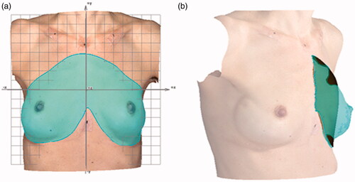 Figure 2. (a) Analysis in VECTRA Analysis Module, measurement of the breast area of interest (turquoise) for calculations of the mean distance between the two breast surfaces (dRMS) as an expression for breast symmetry and (b) volume measurement of the left breast against the interpolated virtual chest wall (brown). Skin marks adjusted in relation to the xyz-plane.