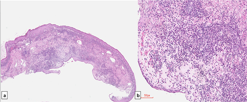 Figure 2 HE stain of skin lesion showed ulcerated dermal abscess with an ill-defined histiocytic component (a). Peripheral granulomata was present with caseation necrosis (b).