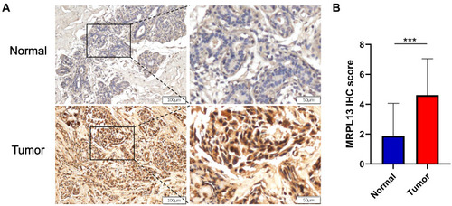 Figure 2 Assessment of the protein expression of MRPL13 in BC tissues and adjacent controls by IHC. (A) Representative photographs of MRPL13 staining in BC and adjacent normal breast tissues. (B) Histogram shows IHC score quantification of MRPL13 in BC and normal tissue groups (n=52). ***p<0.001.