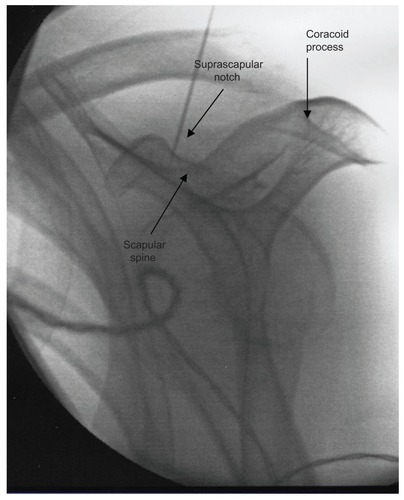 Figure 2 Radiofrequency cannula placed in the wide, blunted V-shaped notch with the patient in the sitting position.