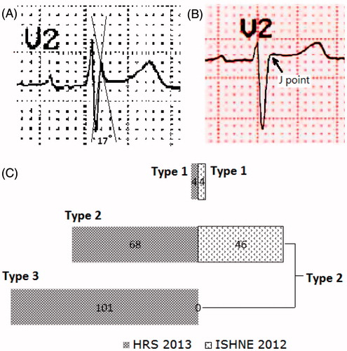 Figure 2. (A). An example of an excluded Brugada-type ECG pattern due to β angle <58° in a 74-year-old woman. (B). An example of an excluded Brugada-type ECG pattern due to J point elevation <0.2 mV in a 66-year-old man. (C). Difference in the numbers of individuals with Brugada-type ECG between 2013 HRS/EHRA/APHRS and 2012 ISHNE criteria. ECG = electrocardiographic; HRS/EHRA/APHRS = Heart Rhythm Society/European Heart Rhythm Association/Asia-Pacific Heart Rhythm Society; ISHNE = International Society for Holter and Noninvasive Electrocardiography.