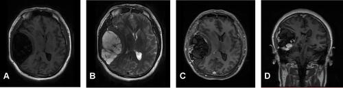 Figure 2 Brain MRI before surgery. Brain MRI showed a huge mass in the right temporal lobe, clear boundary, and multiple separations. The right temporal lobe and lateral ventricle were compressed, the midline structure shifted to the left (A and B). The lesion site showed low signal intensity on T1-weighted images (A) and high signal intensity on T2-weighted images (B). Contrast-enhanced T1-weighted images showed strong enhancement at the boundary (C and D).