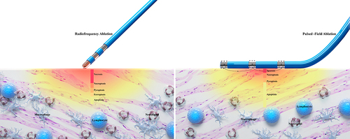Figure 3 Comparison of cell death patterns due to RFA and PFA. RFA causes damage by localized cell necrosis, whereas PFA causes damage by apoptotic cell death. By comparing the schematic diagrams, RFA causes widespread necrosis, and the area of necrosis may contain patterns of death including necrosis, necroptosis, pyroptosis, and ferroptosis. A large accumulation of inflammatory cells such as neutrophils, monocytes and lymphocytes are chemotactic to the migrated area, which in turn induces a strong inflammatory response. Whereas the necrosis by PFA is limited to the area close to the catheter, the wider damage is predominantly apoptotic. There is also relatively little infiltration of inflammatory cells in the migratory zone.
