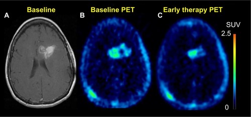 Figure 7 18F-FLT PET.Notes: Sixty-five-year-old female who initially presented with glioblastoma multiforme, now presents after completion of 6 weeks of temozolomide chemotherapy and a total of 60 Gy radiotherapy to the tumor. T1 post-contrast enhanced images (A) demonstrate slight progression as compared to prior study. However, FLT uptake post-therapy (C) was significantly decreased as compared to baseline scan (B). This finding was suggestive of a response to therapy.Abbreviations: FLT, fluoro-3′-deoxy-3′-l-fluorothymidine; PET, positron emission tomography; SUV, standardized uptake value.