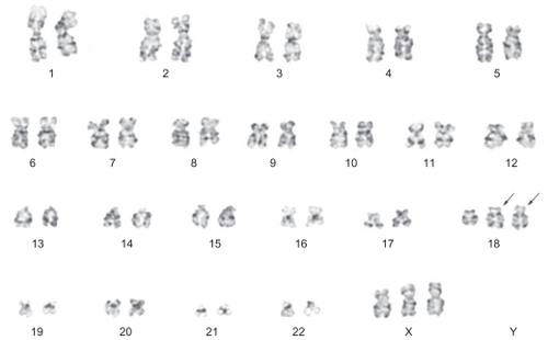 Figure 3 G-banded cytogenetic and spectral karyotyping. G-banded metaphase analysis revealed a 48,XX,+X,add18(q21),+add(18)[11]/46,XX[1] karyotype.