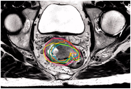 Figure 1. An example from the week-to-week dataset where the GTV delineations of all repeated MRIs are projected on MRIref. Delineation of pretreatment scan (MRIref) is in red, the delineations of the repeated MRIs of week 1–5 are in red, purple, yellow, green, cyan and orange, respectively.