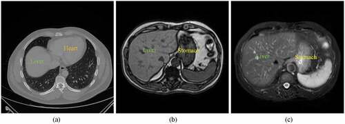 Figure 1. Examples of CT and MR abdominal organ images. (a) a CT image slice in axial view. (b) a T1-weighted sequence of MR image slice in axial view. (c) a T2-weighted sequence of MR image slice in axial view.